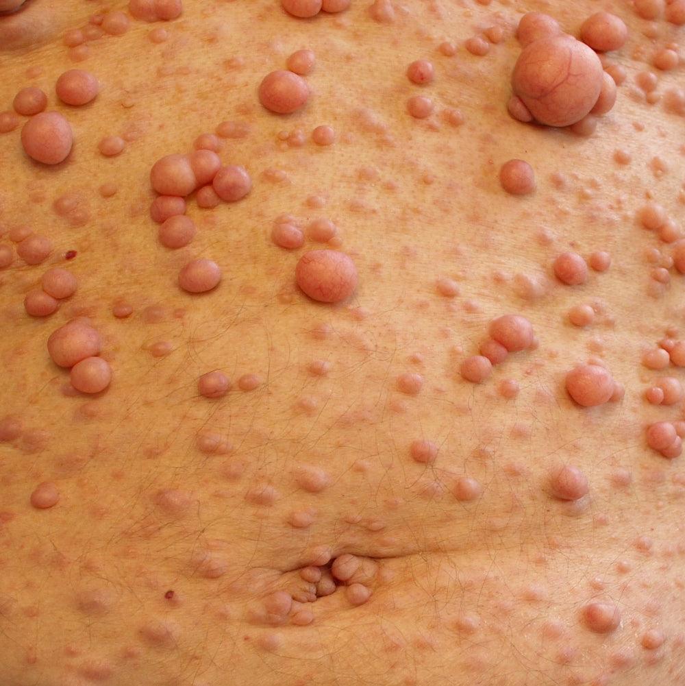 Ionic Foot Detox and Fatty Tumors